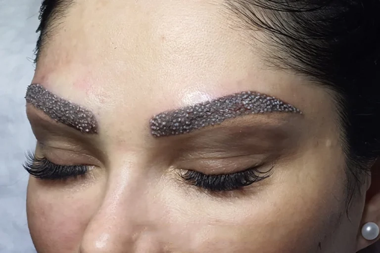 کاشت ابرو با طراحی طبیعی در کلینیک تخصصی کاشت مو سلطانیه